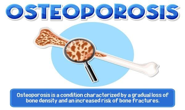Osteoporosis Risk: How to Prevent Bone Loss Before It Starts