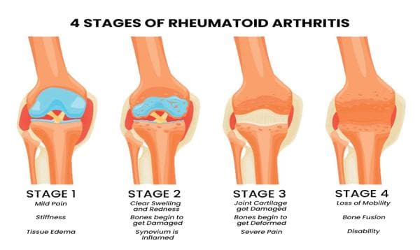 Rheumatoid Arthritis Severity Score: Understanding the Impact
