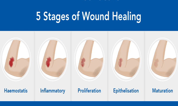Wound Healing Progress: How to Speed Up Recovery